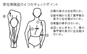 就活中の脊椎側湾症の方