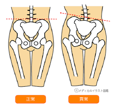 薬や注射では骨盤の歪みは取れません