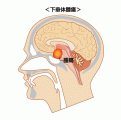 高プロラクチン血症は不妊の原因の1つです。