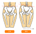 薬や注射では骨盤の歪みは取れません